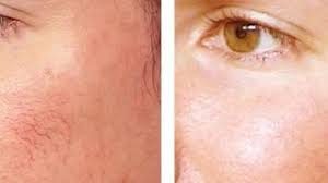 Le Remede De Grand Mere Contre La Couperose Recette Rougeurs Visage Couperose Remede De Grand Mere