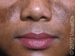 Image result for Melasma