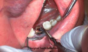 Image result for Tooth Extraction