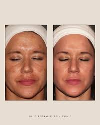 swipe for some of @kelseythroppaesthetics beautiful work!😍🤍 ready for  your next treatment? head to the link in our bio to book with kelsey!  #skintransformation #injectables #cosmeticinjectables  #emilyrockwellskinclinic #booknow #skinclinics ...