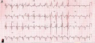 心肌炎 （ 拉丁語 ： myocarditis ），也称为 炎症性心肌病 （ inflammatory cardiomyopathy ），是 心肌 的 炎症 。 症状可表现为 呼吸困难 、 胸口疼痛 （英语：chest pain） 、运动能力降低、 心律不整 等。 æŒ'æˆ°å¿ƒé›»åœ– å¿ƒè‚Œç‚Žå¾Œçš„å¿ƒé›»åœ–é€™æ˜¯å¥½äº†é‚„æ˜¯æ²'å¥½ å£¹è®€