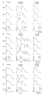 See more camel hump photos. Brugada Syndrome Abstract Europe Pmc