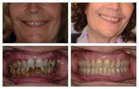 We did not find results for: Dental Dentures Surrey Complete Partial Dentures For Missing Teeth
