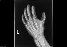 Dislocation Of Thumb Xray Dislocation X Ray Medical Photos