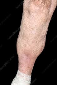 Image result for Lipodermatosclerosis