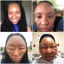 When someone has an allergy to hair dye, they are most likely allergic to one of the chemicals in the dye rather than the entire product. Pics This Woman S Extreme Allergic Reaction Is A Reminder That Not All Henna Is Created Equal Hair Dye Allergy Henna Hair Dyes Henna Hair
