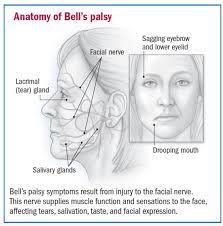 In some of these patients the 8th cranial nerve (auditory nerve, responsible for hearing) may also be infected, producing acute vertigo, deafness and tinnitus (ringing of the ears). Bell S Palsy Core Em