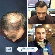 قبل وبعد زراعة الشعر incoming call screenshot