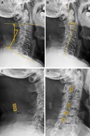 Chiari decompression outcomes using ligamentum nuchae harvest and duraplasty in pediatric patients with chiari malformation type i. Correlation Between The Ossification Of Nuchal Ligament And Clinical Cervical Disorders Sciencedirect