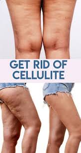 Pin On Cellulite Removal Surgery Cost