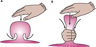 Image result for Hernia Reduction