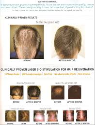 Put a few drops of into your shampoo or dilute it with jojoba oil.one study showed that pumpkin seed increases hair count for men. Laser Bio Stimulation For Hair Rejuvenation Sudbury Skin Clinique