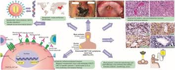 Most patients present with cutaneous patches, plaques, tumors, more rarely with erythroderma. Extranodal Nk T Cell Lymphoma Nasal Type An Updated Overview Sciencedirect