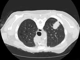 ﻿ ﻿ a ct scan is needed if there is any concern. U S Lung Cancer Screening Experience National Cancer Institute