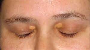 Image result for xanthelasma of eyelid