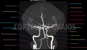 • external carotid artery terminates where it becomes the: Time Of Flight Tof Mr Angiography Of The Brain