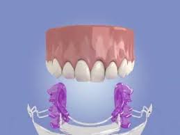 Now in my practice, we have three types of orthodontic options for you, you ca. Inman Aligner How It Works Youtube