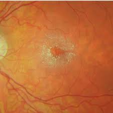 Pdf Sjogren Larsson Syndrome In Clinical Practice