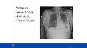 I have recently learned that the manufacturer of the dreamweaver cpap (phillips) is recalling these machines. Multifocal Lung Cancer Discussion And Case Presentation Mayo Clinic Youtube