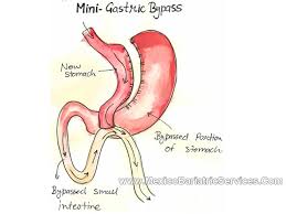 9.3 %, p = 0.449). Cost Of Mini Gastric Bypass In Mexico