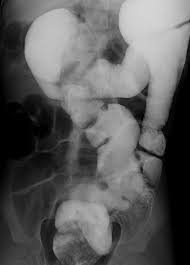 Image result for Intestinal Malrotation