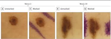 Comparing your skin lesion to skin cancer images found online cannot replace medical examination. Eric Topol On Twitter How Surgical Skin Markings Faked Out A Deep Learning Ai Neural Net A Commercially Approved Product For Algorithm Aided Melanoma Diagnosis Highly Instructive Machines Can Be Dumb Https T Co Llagqwgkly Jamaderm