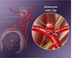 Talk with a doctor about the potential complications after craniotomy surgery before undergoing this procedure. Brain Aneurysm Surgery In India Medtravels
