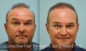 Draw the eye to your package with a distinctive line of hair. Beard Hair Transplant To Head Yes Or No Impact Of Hair Loss Forum