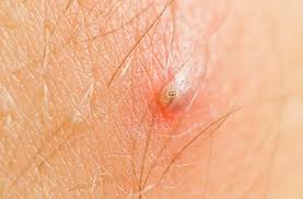 Ingrown hair is a condition where a hair curls back or grows sideways into the skin. Q A Expert Explains Best Way To Handle Your Ingrown Hair Health Essentials From Cleveland Clinic