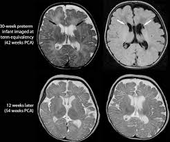 We did not find results for: Evolution Of A Focal Cystic Pvl In An Infant Born At 30 Weeks Pca Download Scientific Diagram