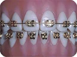 Solid neutrals, mattes or metallics, vibrant glossy. Welcome To Golden Orthodontics Cheryl B Golden Dds