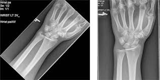 Sports Injury Bulletin - Diagnose & Treat - Ulnar Impaction Syndrome