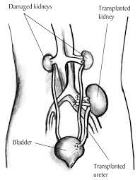 In the human body, the kidneys are located vertically in the middle of the abdomen near the back wall. Drawing Of A Transplanted Kidney Inside An Outline Of The Abdomen Media Asset Niddk