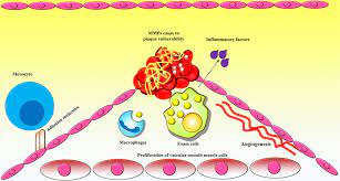 Inflammatory Markers Related To Innate And Adaptive Immunity In Athero Jir