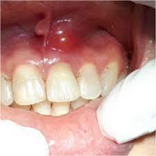 أنواع التهاب اللثة بالصور ويب طب