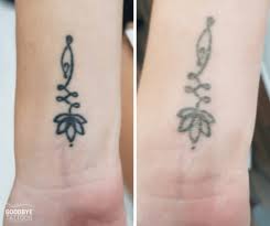 This treatment provides customized solutions, treating mild to moderate sun damage, fine lines and wrinkles, reduction of acne scars and surgical scars, improved overall texture of the skin, and skin tightening. Why Does Laser Tattoo Removal Cause Frosting Goodbye Tattoos Sydney