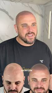 Scalp micropigmentation sessions 1,2&3 ⏩⏭️☑️