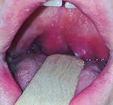 The arches form the pillars of the fauces. Racgp The Longstanding Sore Throat