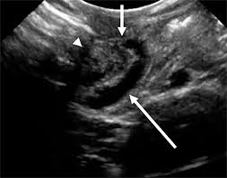 Image result for Midgut Volvulus