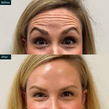 🥳 BOTOX, FILLER & PDO SMOOTHING THREAD PARTY ****Jan 11th and starts at  3pm but you can come in the evening after normal works hours just let me  know what time you'd