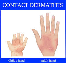 Image result for dermatitis contacta children