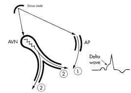 Avnrt occurs when a reentrant circuit is present within the av node. Paroxysmal Supraventricular Tachycardia Psvt Crossfit Santa Cruz