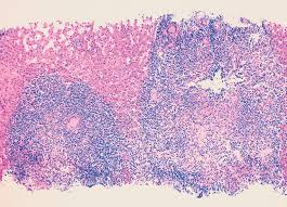 Primary Biliary Cirrhosis And Primary Sclerosing Cholangitis A Review Featuring A Women S Health Perspective