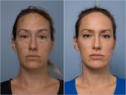 This was a personal choice, if you don't like cosmetic. Cosmetic Before And After Gallery Dr Wendy Wong