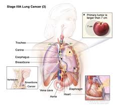 If you've been smoking for a long time, you may be at greater risk for developing lung cancer. Non Small Cell Lung Cancer Treatment Pdq Treatment Patient Information Nci Michigan Medicine
