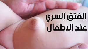 الفتق السري عند الاطفال وطريقه علاجه Umbilical Hernia Youtube