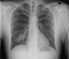 Maybe you would like to learn more about one of these? Pneumothorax 1 Sono Atlas Rastislav Simek Atlas Of Chest Sonography Ultrasonography