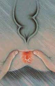 Tromboză hemoroidale dureri acute în zona anala poate provoca, de asemenea tromboza acută de hemoroizi. Fisuri Anale Laurusmedical Hemoroizi Varice Dermatologie Gastroenterologie