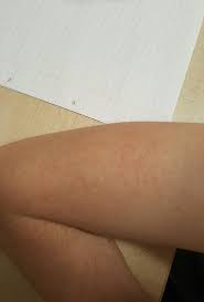 Skin Concerns I Ve Got These Red Marks On My Arms I Think From Where I Ve Picked At Dry Skin Around Hair Follicles Anyone Kn Skin Skin Concern Hair Follicle