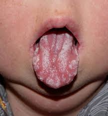 Apa penyebab thrush oral pada bayi. Oral Thrush Pada Bayi Mycosis Articulated
